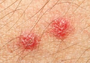 bed bug bites